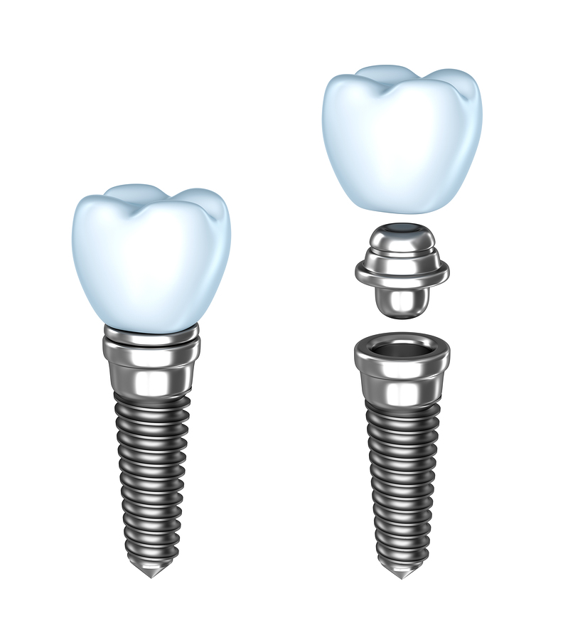 Dental Implants - Dentist In Depew, NY | Hillview Family Dental 